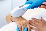 laser hand rejuvenation