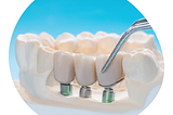 best dental implant in bangaloreBeyond Smiles : Best Dental Implants In Bangalore