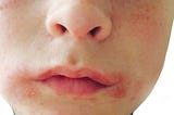 What Triggers Angular Cheilitis?