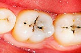 What does a cavity look like — Covering Info