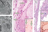 Clinical trials using nitric oxide gas and BCG may reveal a common link to Coronavirus’ weakness