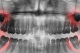 Start by getting an assessment of your wisdom teeth