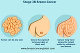 What is the meaning of stage 3 breast cancer?