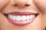 What is the best way to correct smile design?