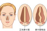 鼻中隔彎曲開刀經驗