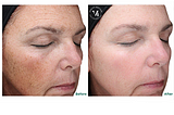 5 Amazing Benefits of VI Peel Precision Plus | Prescott Medical Aesthetics