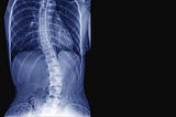 Study identifies possible cause of scoliosis