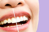 TEETH WHITENING IN ISLINGTON