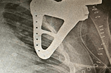 Use of 3D printed customized implant for scapula reconstruction in total scapulectomy surgery for…