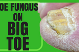 Toenail Fungus on Big Toe