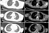 The Challenge Management of a Child with Cervical Spinal Cord Injury with Ultrasound Assessment of…