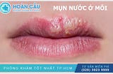 Bạn có biết mụn nước ở môi là bệnh gì không?