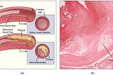 Protein regulating inflammation in atherosclerosis identified