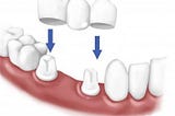 Các bước thực hiện dịch vụ bọc răng sứ thẩm mỹ nha khoa