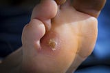 When to Seek Professional Help for Foot Calluses: Signs You Shouldn’t Ignore