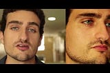 Tips to Change Your Eye Color Permanently Through Iris Implant Surgery
