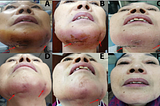 Elizabethkingia Anopheles Infection after Hyaluronic Acid Injection: A Case Report and Review