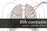 Rib contusion: causes, symptoms and care