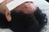 Successful Treatment of Herpetic Itch with Traditional Chinese Acupuncture and Cotton-Moxibustion…