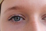 How To Treat Eczema Around Eyes Causing Wrinkles GrezHost