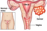 Pengobatan Kista Endometriosis Tanpa Operasi / Obat Herbal Kista Endrometriosis/ Penghancur Kista…