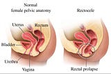 Biết ngay có bị sa tử cung hay không với các hiện tượng sa tử cung