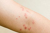 What is Dermatitis Herpetiformis?