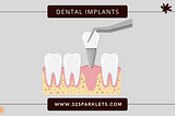 dental implants, dental implants in mohali, mohali dentist, best dentist in mohali