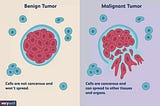 Machine Learning — Logistic Regression Model for Breast Cancer Probability & Detection