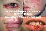 Cara Menyembuhkan Herpes Di Tangan dan Badan