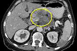 Pancreatic adenocarcinoma