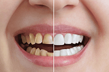 This article is about Zoom Teeth Whitening vs other whitening methods