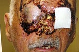 The “Miami Zombie” Attack on Ronald Poppo