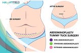 Rediscover Your Confidence with a Tummy Tuck in Turkey