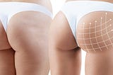 You can make your buttocks bigger and rounder with butt implants.