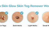 Allura Skin Glow Skin Tag Remover Reviews: 100% Natural and Function