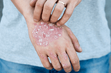 What is eczema? How to get rid of eczema? Types, Causes and Treatment