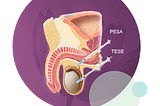 Sperm retrieval — PESA & TESA