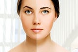 Permanent Skin Whitening Treatments in Dubai Breaking Down the Myths and Realities