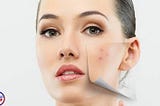 natural ingredients to get rid of pimples