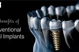 Top Benefits Of Conventional Dental Implants- Dr Jatinder Sharma DDS