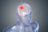 Glioblastoma: The Cancer of Brain