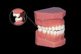 Are Dental Implants An Option If I Grind My Teeth?