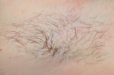 Laser Hair Removal Before