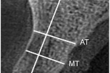 Microscopic and Tomographic Analyses of Alveoli Repaired by Three Alveolar Preservation Techniques…