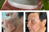 燒燙傷、被火紋身，用CBD油+NMN乳液修復皮膚加速復原