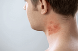 What is Dyshidrotic Dermatitis?