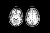 12 Age-Reversing Habits: How I Made My Brain 10 Years Younger