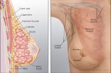 Breast cancer disease