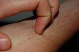 Acute itching in eczema patients linked to environmental allergens